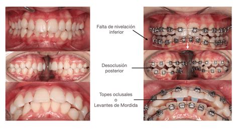 Levante De Mordida En Ortodoncia T cnicas Efectivas Y Beneficios Levante De Mordida En Ortodoncia T cnicas Efectivas Y Beneficios