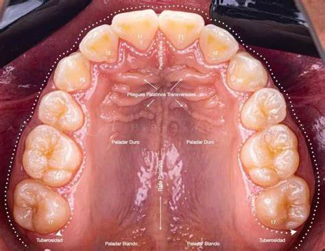  Descubre Por Qu Aparecen Dientes En El Paladar Y C mo Solucionarlo 