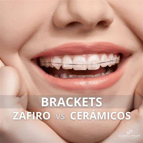 Descubre Los Mejores Aparatos Ortop dicos Para Dientes Tipos Precios 