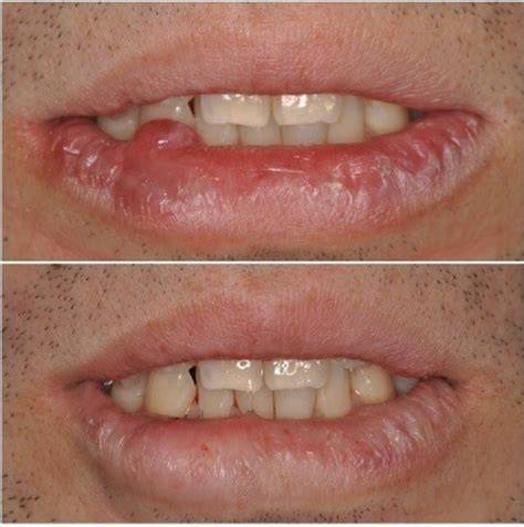 Mucocele Oral Descubre Las Causas Tratamientos Efectivos Y C mo 