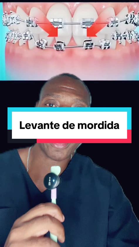 Topes Para Ortodoncia Descubre Los Tipos Y C mo Colocarlos Topes Para Ortodoncia Descubre Los Tipos Y C mo Colocarlos
